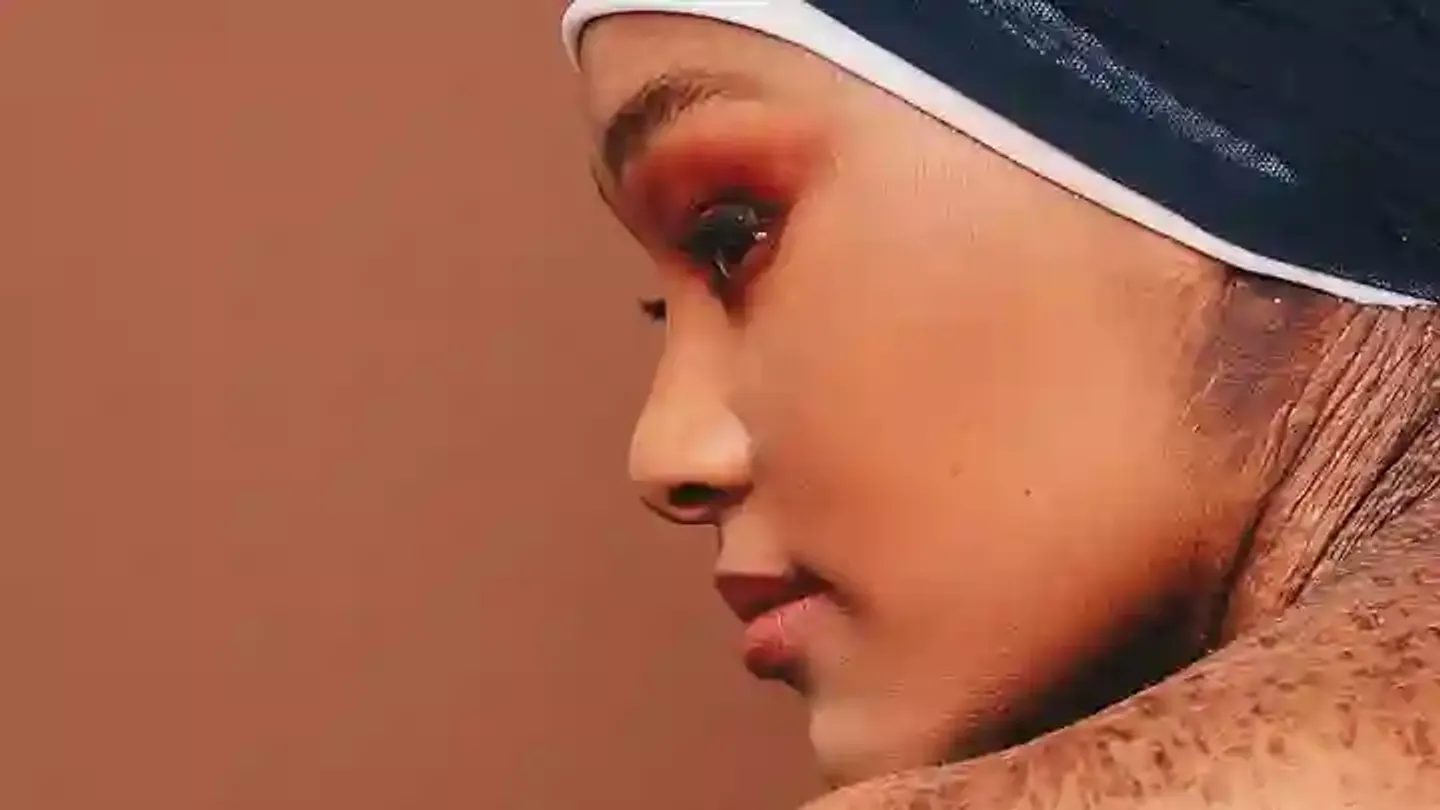 Zoey Seboe: Matashiyar da ta yaƙi ƙyamar da ake mata saboda cutar fata ta lamellar ichthyosis