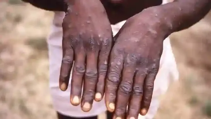 Da Monkeypox a Mpox: la storia oscura del razzismo nella denominazione delle malattie