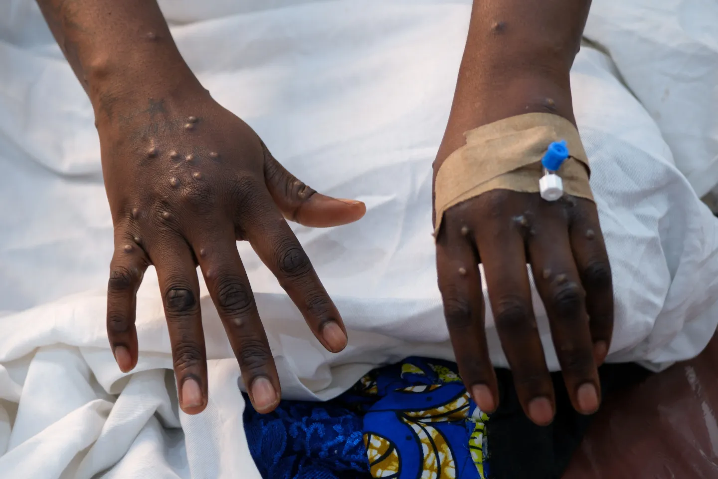 Ethiopia yathibitisha maambukizi ya kwanza ya ugonjwa wa mpox kwa mtoto mchanga na mama
