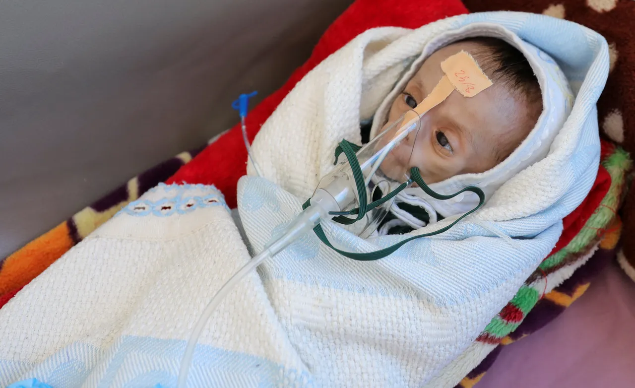 Yemen's West Coast on brink of 'catastrophe' due to acute malnutrition: UNICEF