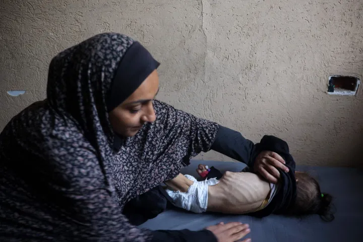 UN reports more than 60,000 children suffering malnutrition in Gaza