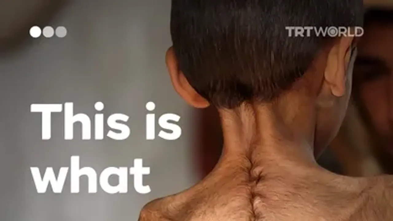 Gaza starving under siege