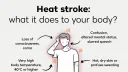 Heat stroke