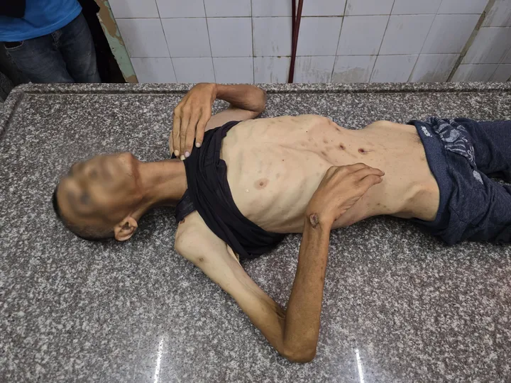 Gaza records 45 cases of acute flaccid paralysis amid worsening famine under Israeli siege