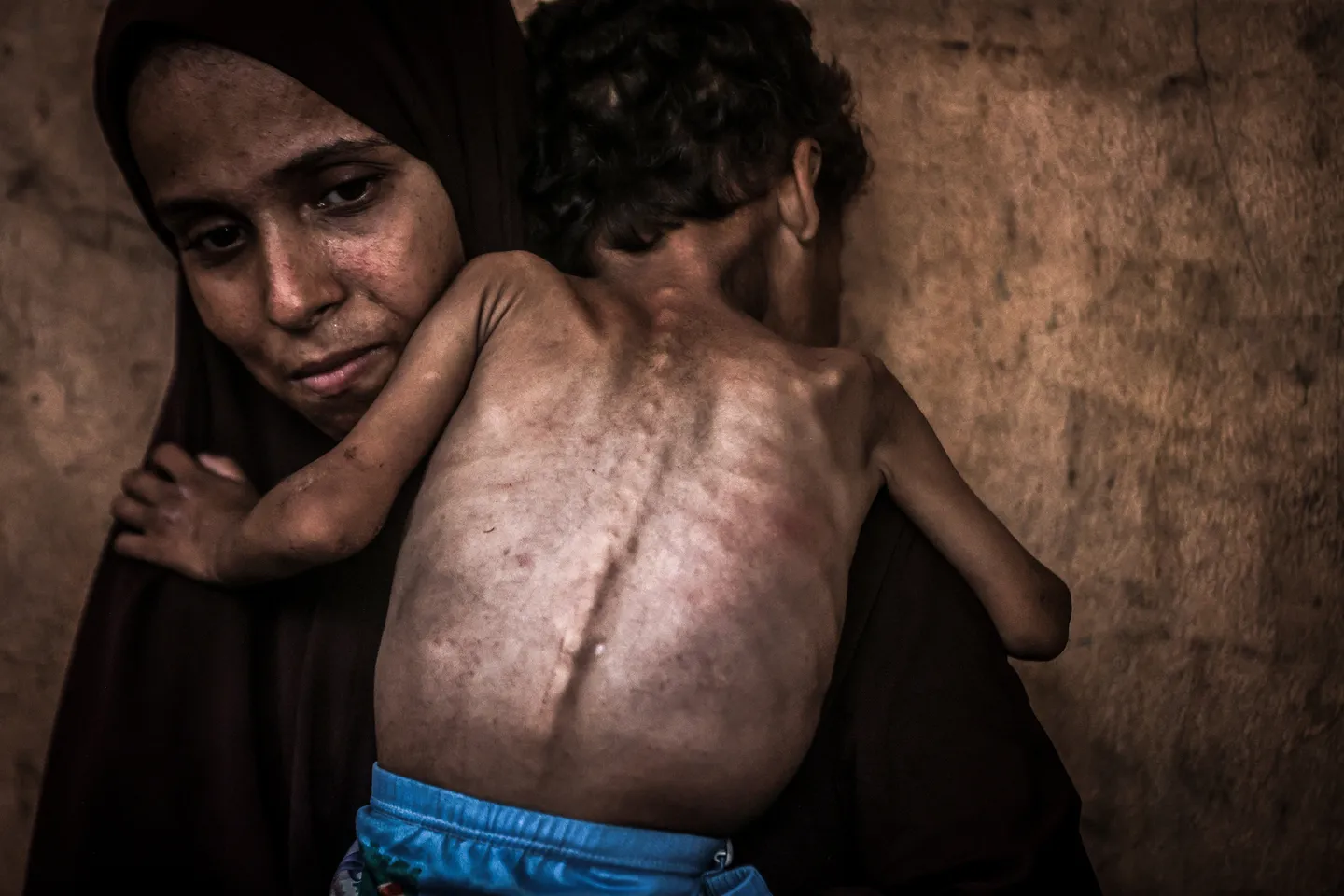 Mbretëria e Bashkuar do të evakuojë fëmijët që kanë nevojë për ndihmë urgjente mjekësore në Gaza
