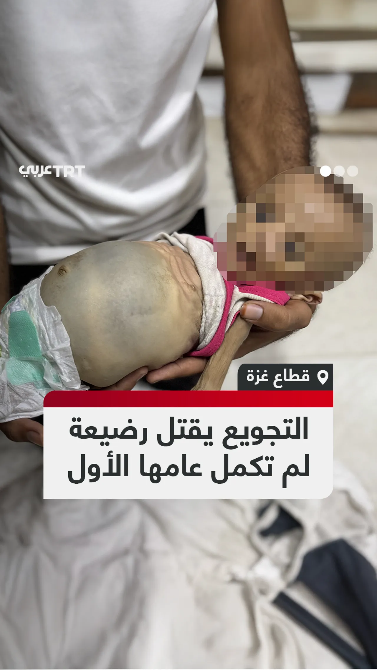 التجويع يقتل رضيعة لم تكمل عامها الأول