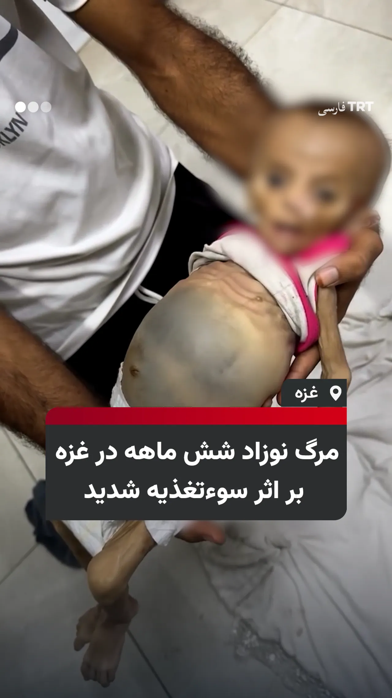 مرگ نوزاد شش ماهه در غزه بر اثر سوءتغذیه شدید