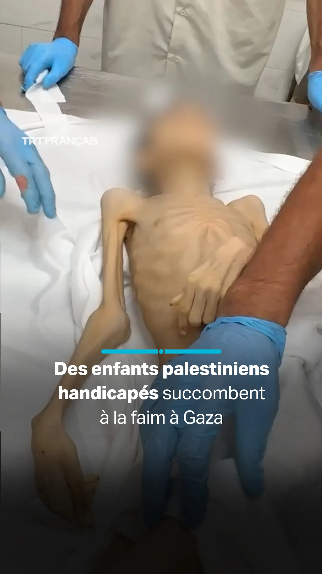 Deux enfants meurent de malnutrition à Gaza