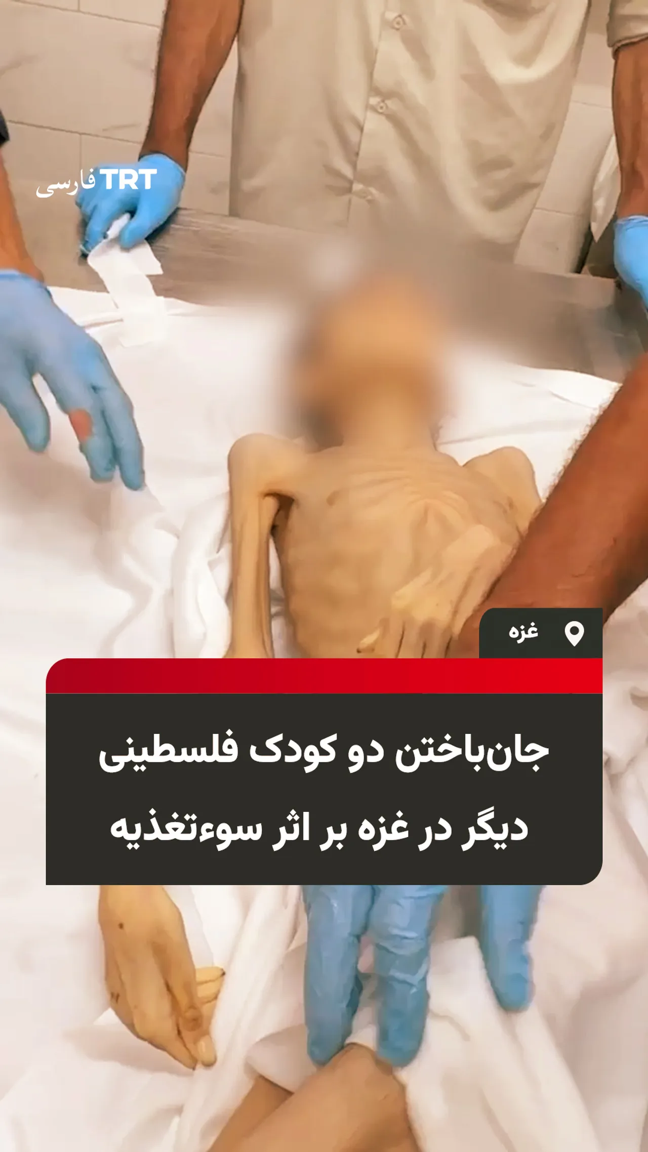 جانباختن دو کودک فلسطینی دیگر در غزه بر اثر سوءتغذیه