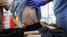 Një adoleshent palestinez vdes nga uria në Gaza për shkak të kufizimeve izraelite të ndihmave