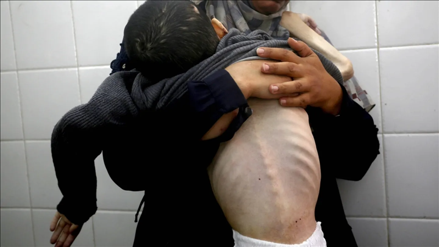 Vdes një tjetër fëmijë nga uria në Gaza mes rrethimit të vazhdueshëm izraelit