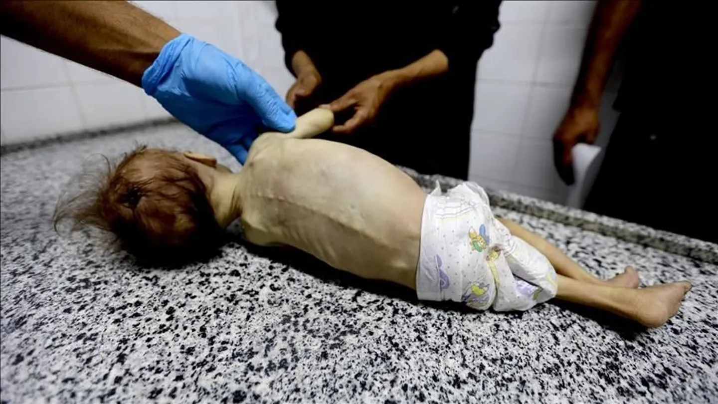 Një tjetër foshnjë palestineze vdes nga kequshqyerja e rëndë në Gaza për shkak të rrethimit izraelit