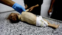 Një tjetër foshnjë palestineze vdes nga kequshqyerja e rëndë në Gaza për shkak të rrethimit izraelit