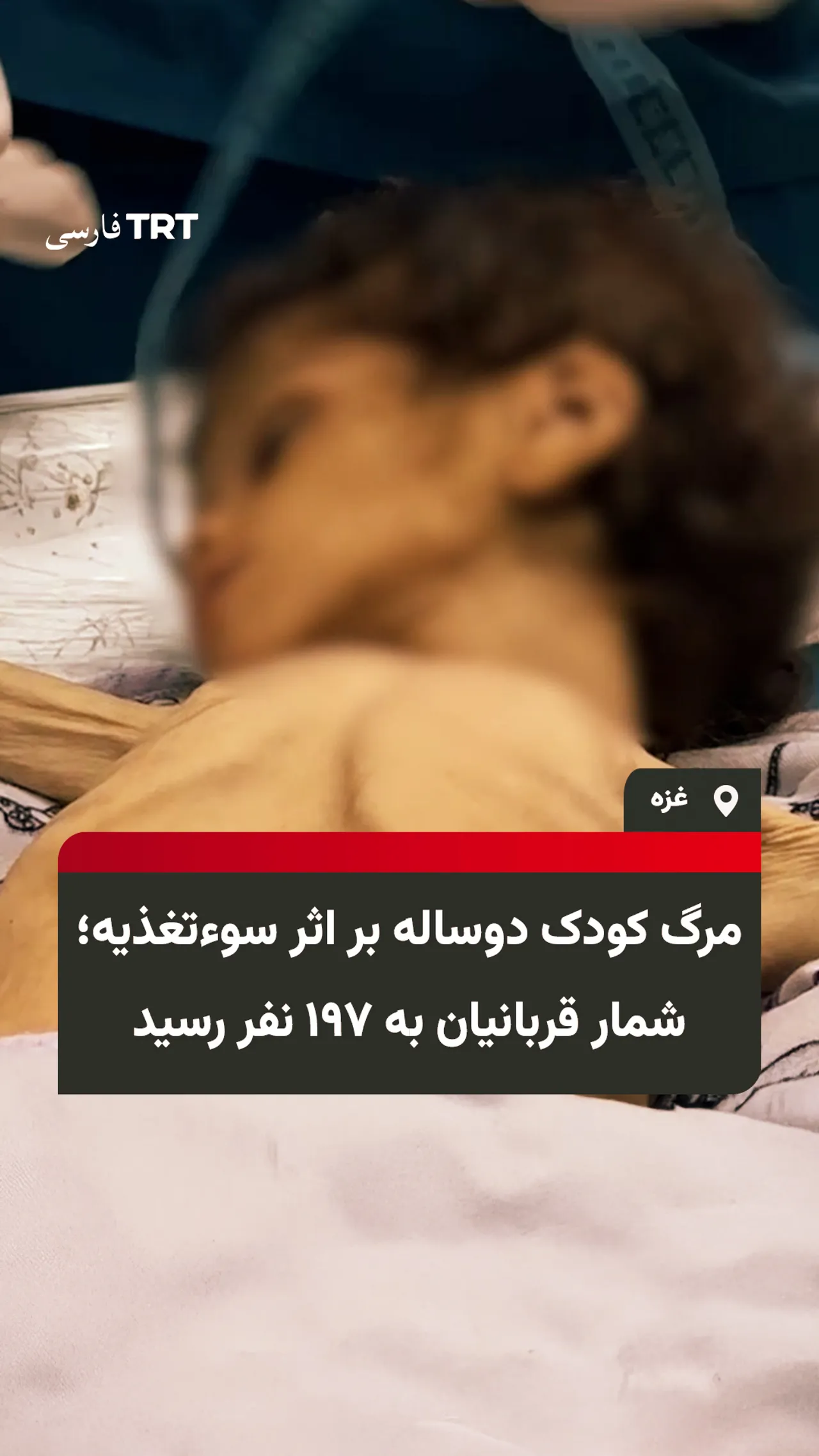 مرگ کودک دوساله بر اثر سوءتغذیه؛ شمار قربانیان به ۱۹۷ نفر رسید