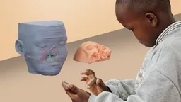Face reconstruction: A second chance for Kenyan boy shot by bandits
