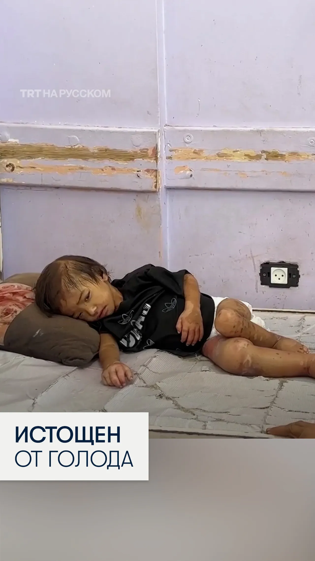 Двухлетний малыш умирает от голода на глазах у родных