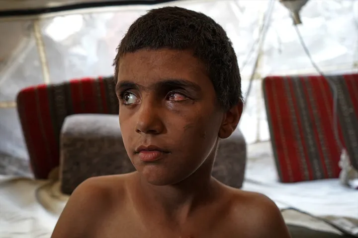At least 21,000 children disabled in Israeli war on Gaza: UN committee