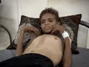 UN: Mindestens 21.000 Kinder haben im Gaza-Krieg Behinderung davongetragen