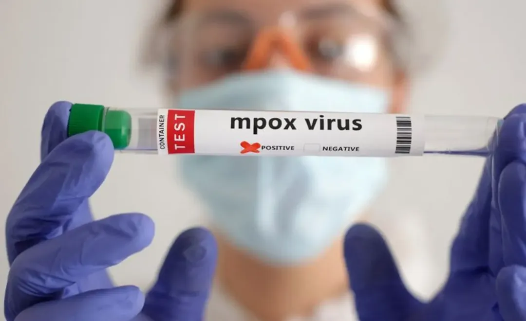 Kluster Mpox babit empat sekeluarga dikesan, situasi terkawal – KKM