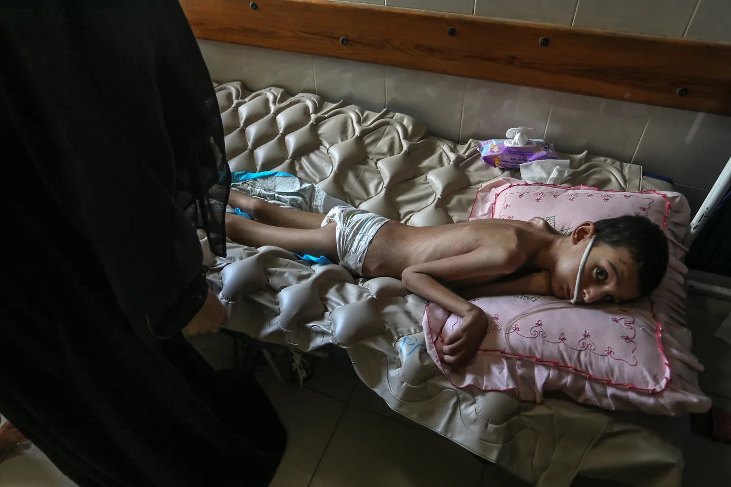 6 njerëz të tjerë vdesin nga uria në Gazën e shkatërruar nga kequshqyerja e rëndë