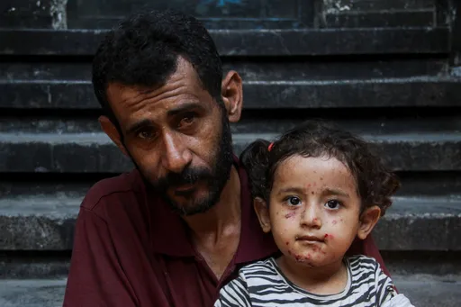 Skin infections surge in Gaza displacement sites as shelter shortages worsen: UN