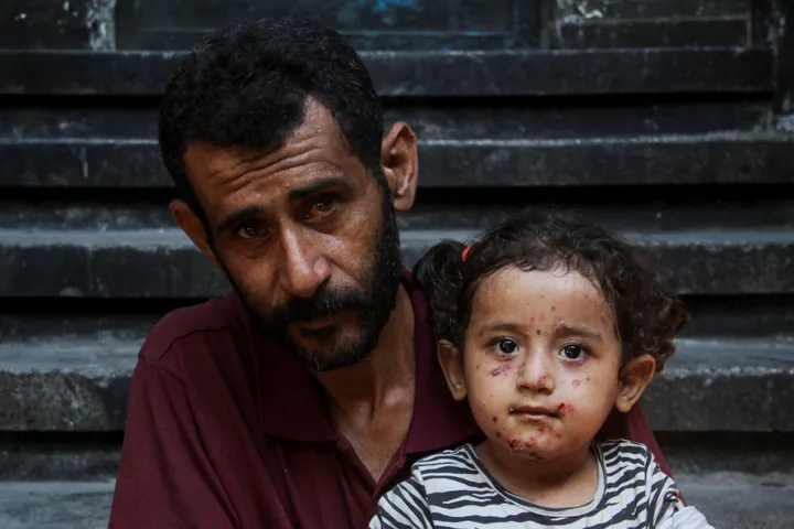 Skin infections surge in Gaza displacement sites as shelter shortages worsen: UN