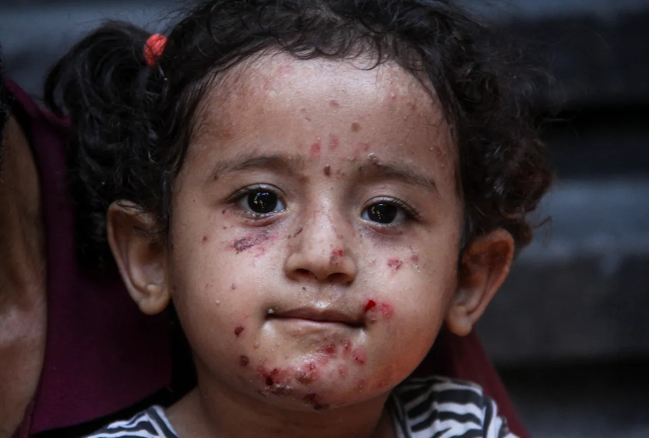 В Газе рост кожных заболеваний