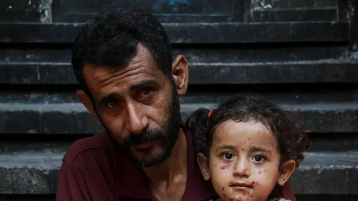 سازمان ملل: عفونت‌های پوستی در میان آوارگان غزه بیش از سه برابر شده است