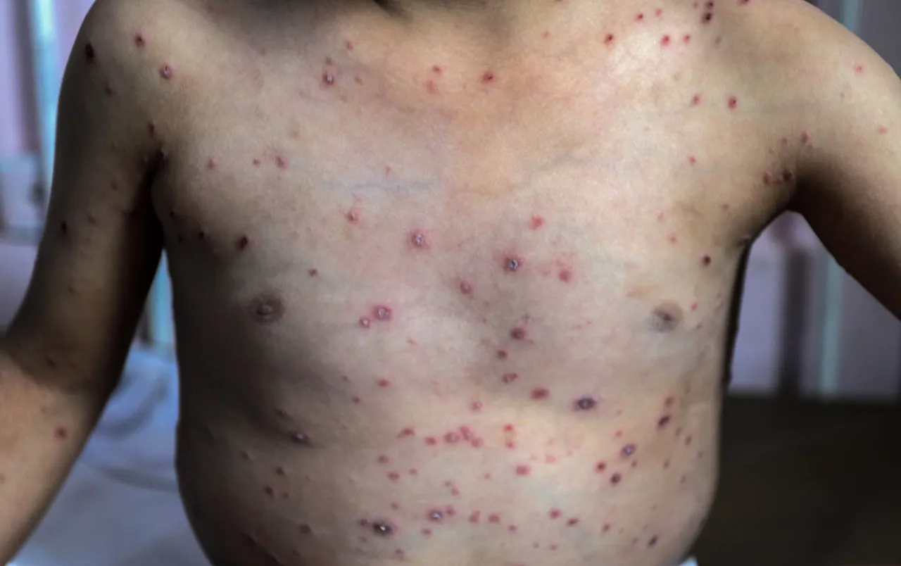 Gaza: flambée d’infections cutanées chez des milliers de patients, alerte l’UNRWA
