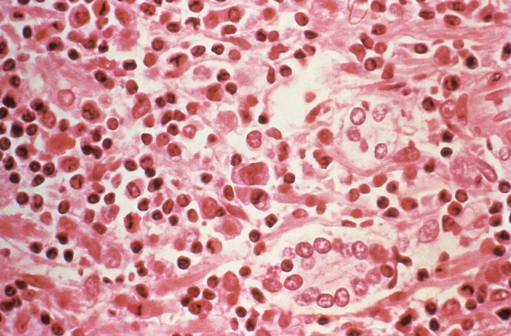 WHO ta ce duniya ba ta fuskantar barazana bayan ɓullar cutar hantavirus a wani babban jirgin ruwa
