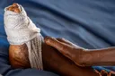 Leprosy: Why one of the oldest diseases afflicting humanity is still a threat