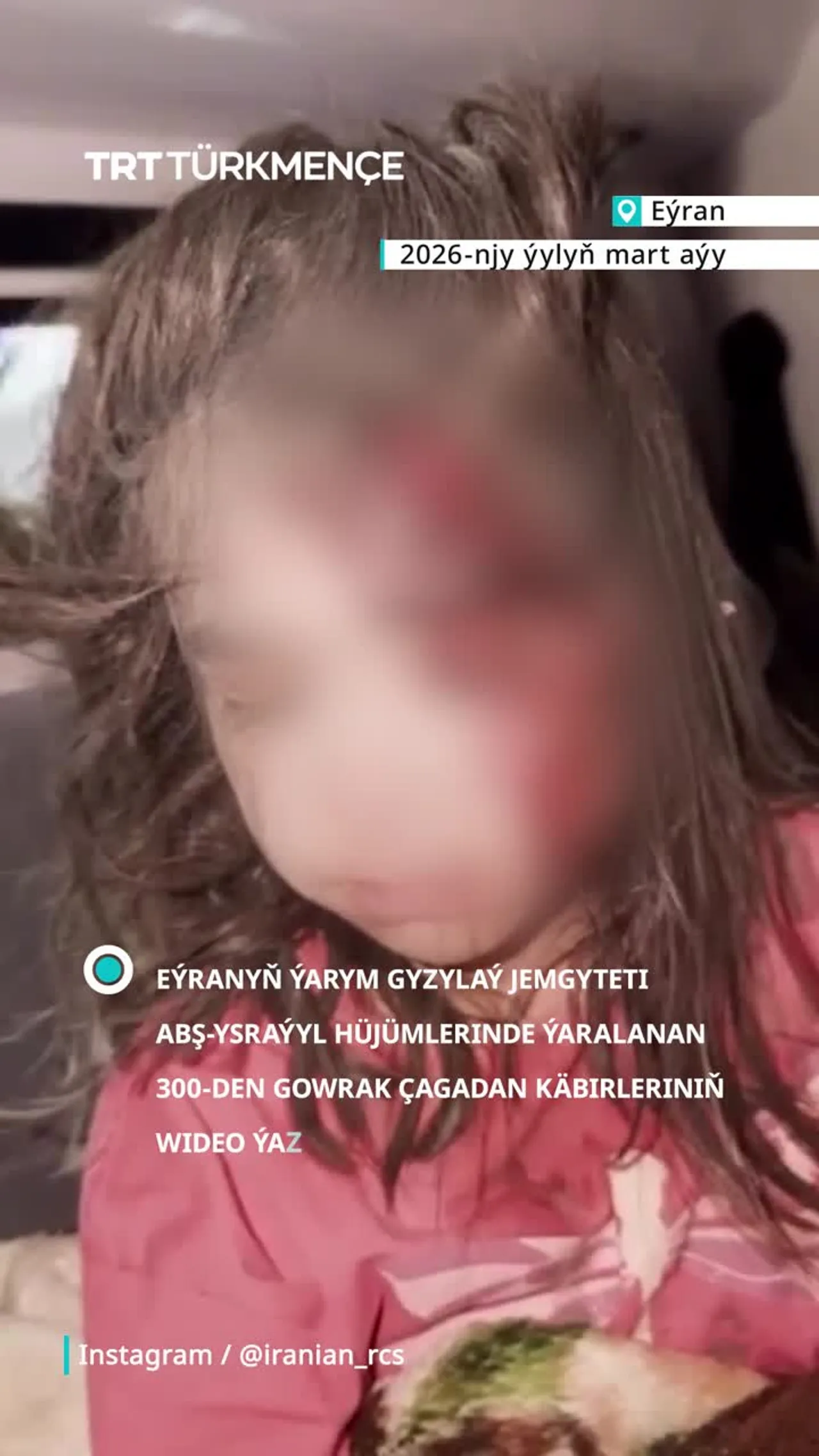 ABŞ-Ysraýyl hüjümlerinde ýaralanan 300-den gowrak çagadan käbirleriniň wideo ýazgylaryny ýaýradyldy